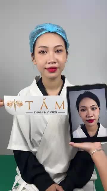 Ca cân chỉnh thái dương, má tại phòng khám TMV Tấm.