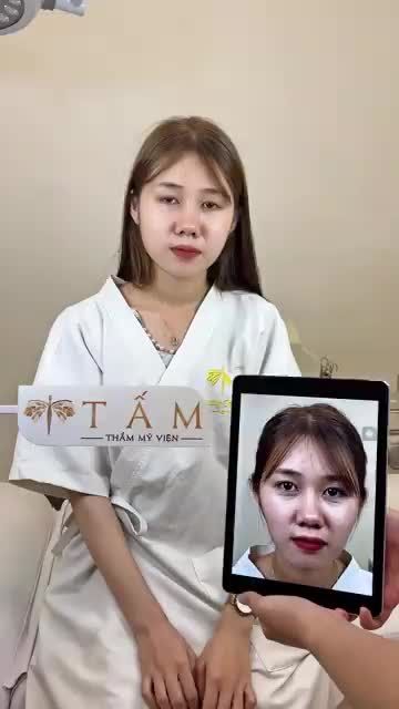 Cân chỉnh gương mặt cho bạn Ngọc Hạnh - KH Filler má, cằm tại Tấm.
