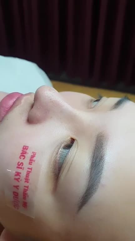 Nâng Mũi Aline tự tin nhìn góc nào cũng thấy mình xinh