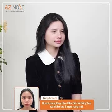 Cảm nhận của khách hàng từng t.iêm filler đến từ Đồng Nai sau 8 ngày nâng mũi