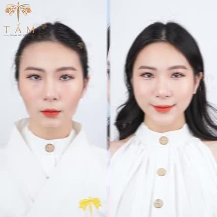 "Khuôn mặt hoàn hảo với Filler Má - Cằm tại Tấm đẹp ngay chỉ sau 30 phút"