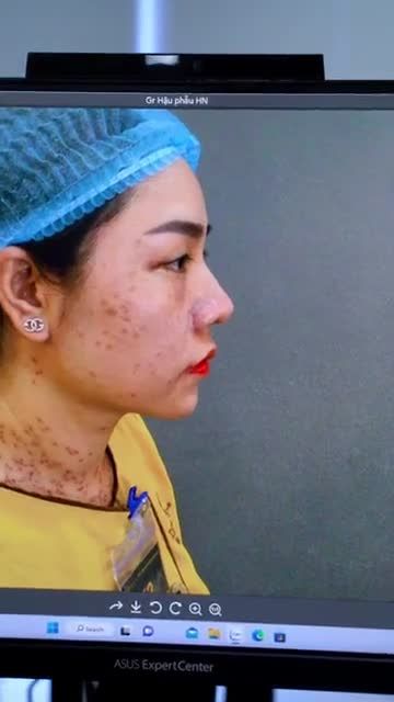 Thu cánh mũi có đau không? Cả nhà cùng theo dõi tại đây