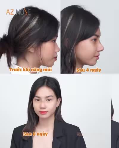 Nâng mũi có khiến khuôn mặt "dừ" hơn