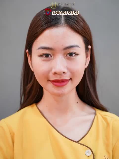 Nghe đồn: Nâng mũi Dr Hải Lê- Sài Gòn đẹp lắm, dáng mũi cao bay, thanh thoát và vô cùng tự nhiên.