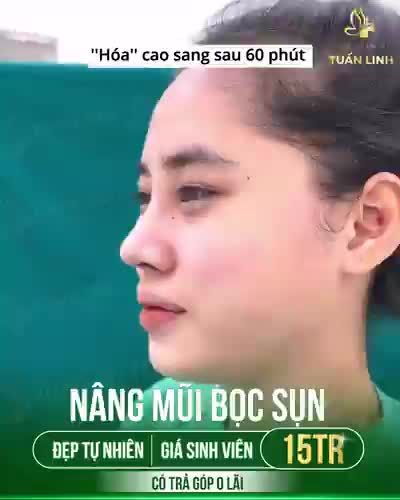 NÂNG MŨI BỌC SỤN ĐẸP TỰ NHIÊN GIÁ SINH VIÊN