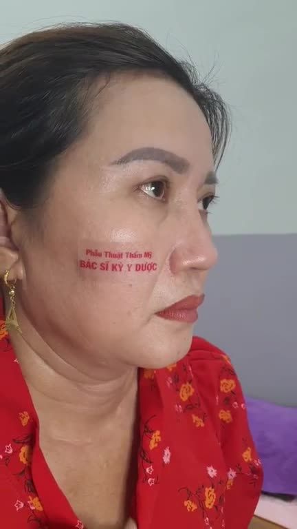 Nâng mũi Aline - Dáng mũi đẹp chuẩn sau 3 tháng.