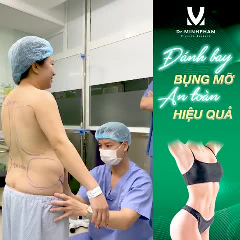 Bụng to, nhiều mỡ thừa Bụng xổ, sẹo mổ đẻ xấu xí Bụng chảy xệ, da nhăn rạn, chùng nhão