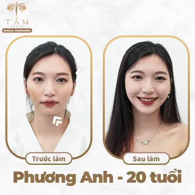 Flex nhẹ vài ca cân chỉnh gương mặt bằng filler tại Thẩm Mỹ Viện Tấm
