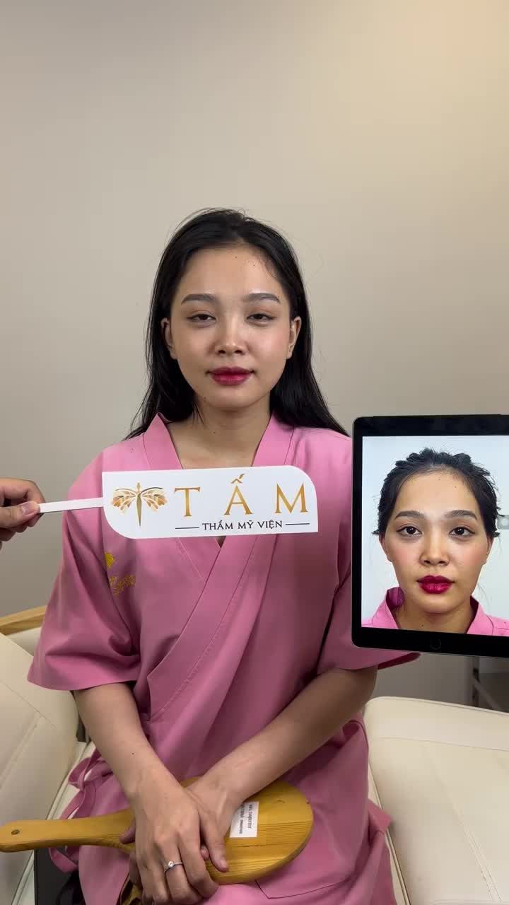 Thay đổi hoàn toàn sau khi sử dụng filler má, thái dương để cân chỉnh đường nét gương mặt.
