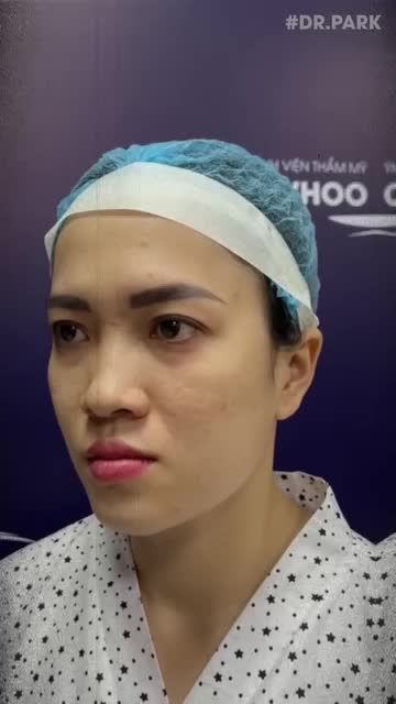 NÂNG MŨI CẤU TRÚC - PHƯƠNG PHÁP DUY NHẤT MANG LẠI DÁNG MŨI HOÀN HẢO