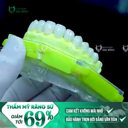 TRỢ GIÁ 69% BỌC RĂNG SỨ THẨM MỸ  RĂNG SỨ CHÍNH HÃNG – ĐẸP KHÔNG TÌ VẾT – BẢO HÀNH TRỌN ĐỜI