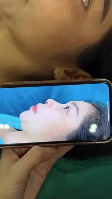 Case mũi cấu trúc surgiform được 10 ngày