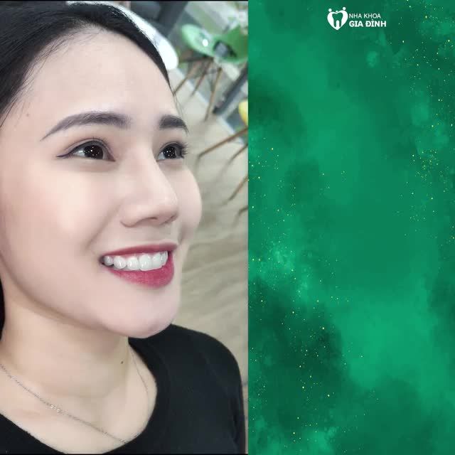 TẠM BIỆT RĂNG XẤU – ĐÓN NỤ CƯỜI XINH