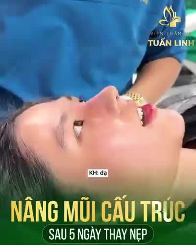 NÂNG MŨI CẤU TRÚC - KẾT QUẢ SAU 5 NGÀY THAY NẸP