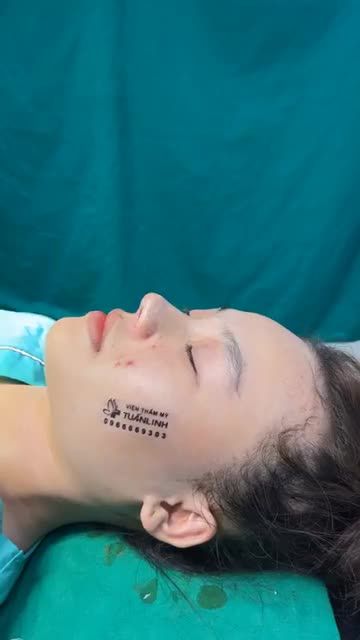 Case mũi bọc sụn vừa hoàn thành