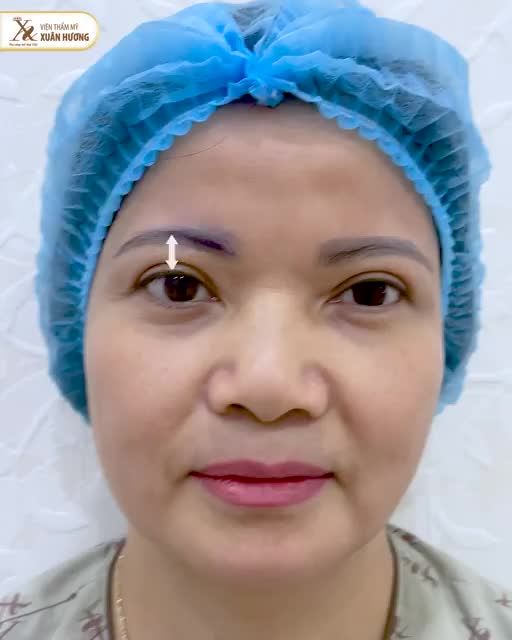 Bạn có biết Nâng cung mày có thể thực hiện theo 2 đường là  - Nâng cung mày phía trên chân mày  - Nâng cung mày phía dưới chân mày