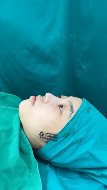 Case mũi bọc sụn vừa hoàn thành
