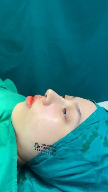Case mũi cấu trúc vừa hoàn thành