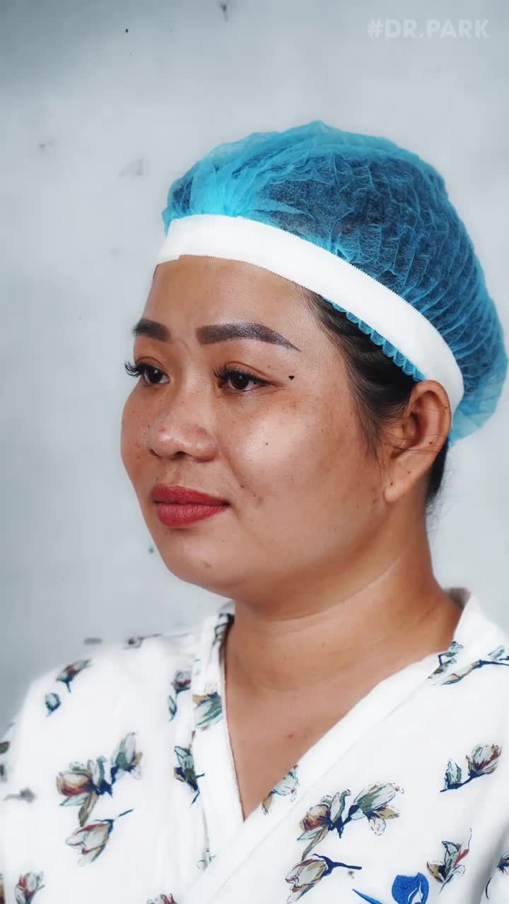 NÂNG MŨI CẤU TRÚC – XU HƯỚNG NÂNG MŨI HIỆN NAY