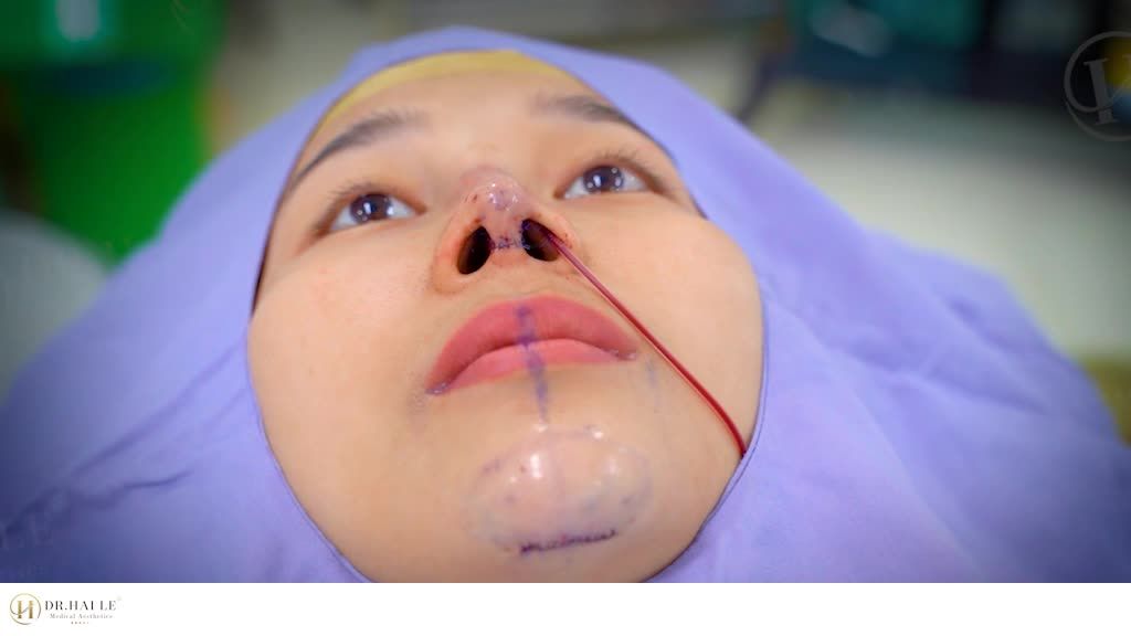 Combo Nâng mũi + Độn cằm mọi góc độ trông sẽ như thế nào?  Theo dõi hết 60s bạn nhé!