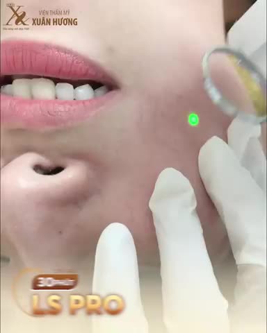 Mạch máu đỏ li ti lộ rõ vẻ yếu ớt . Makeup che khuyết điểm nhiều càng khiến da thêm yếu, mao mạch lộ rõ hơn.