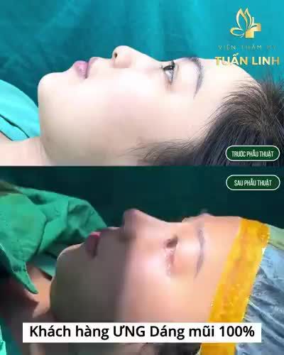 NÂNG MŨI SỤN TAI SLINE - 15TRIỆU - GIÁ TRỌN GÓI - TRẢ GÓP % LÃI SUẤT