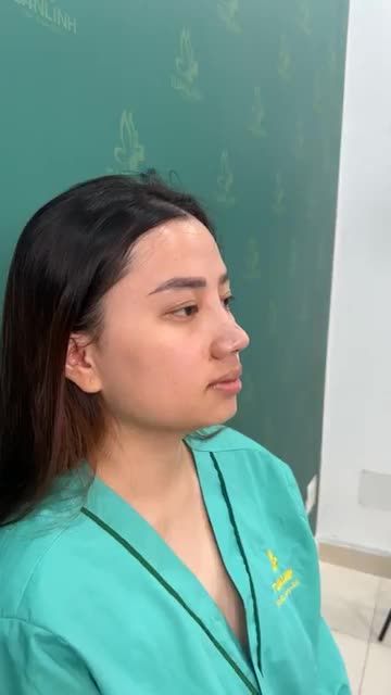 Case mũi bọc sụn vừa hoàn thành