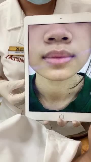 Môi thâm đến đâu cũng xử lý được