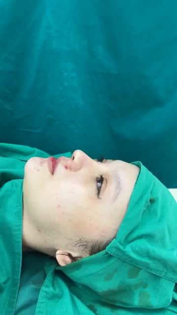Case mũi cấu trúc vừa hoàn thành