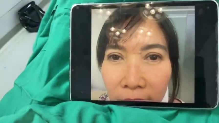 Mùng 1 đầu tháng, Dr Vương triển khai kỹ thuật: Độn thái dương, sửa mí trên cắt mí dưới cho cô giáo đến Mỹ Đình, HN