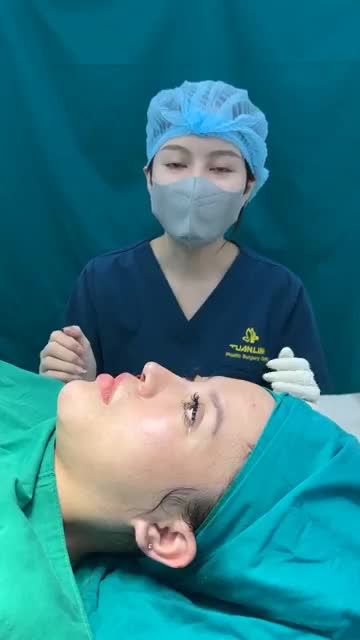 Case mũi cấu trúc sửa lại cho bạn gái đến từ Đà Lạt