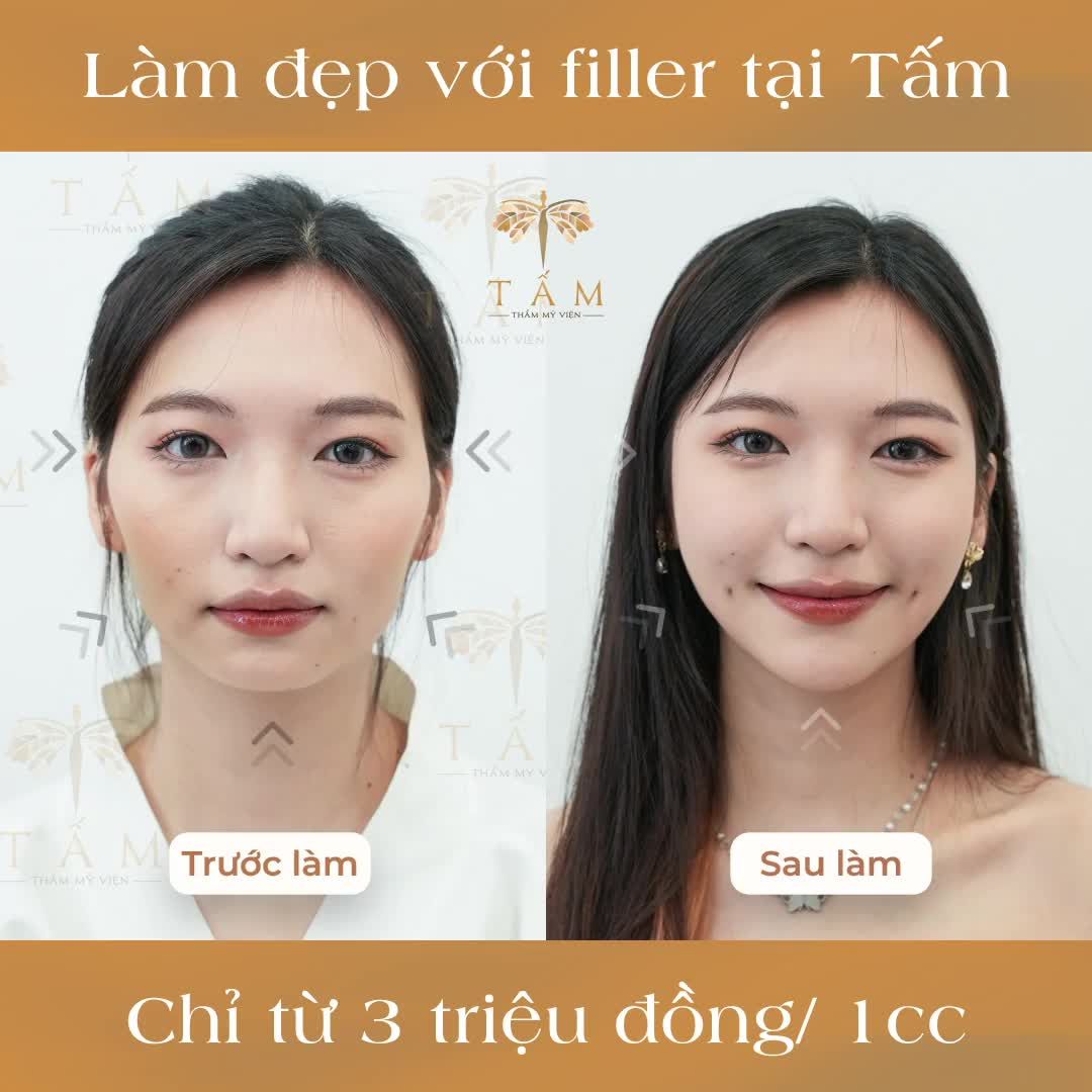 Tự tin tỏa sáng với filler tại Tấm chỉ từ 3 triệu đồng/1 cc
