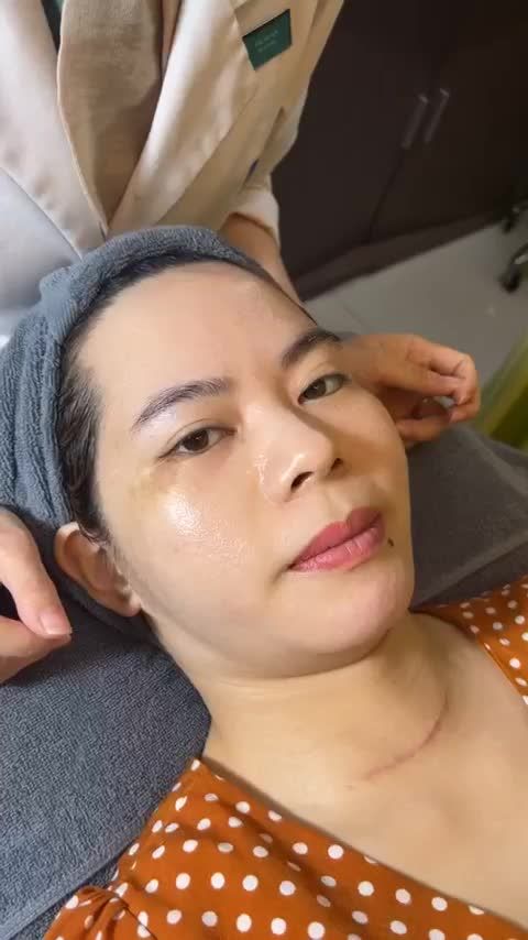 BẤT NGỜ Tiêm trẻ hóa Baby Skin U40 sở hữu LÀN DA MỊN MÀNG TRẮNG HỒNG như DA EM BÉ chỉ sau 1 lần
