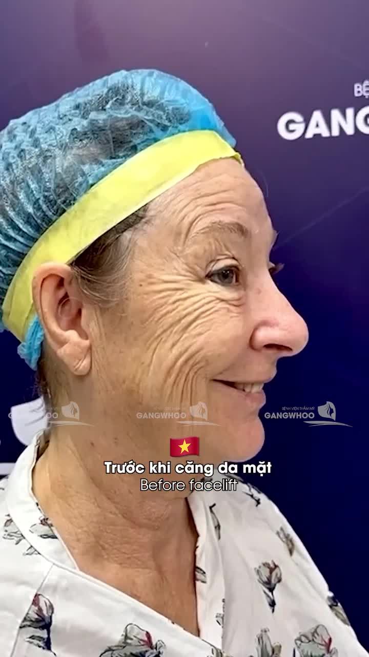 BẤT NGỞ TRƯỚC BÍ QUYẾT TRẺ HÓA TỪ CĂNG DA MẶT BẰNG CHỈ