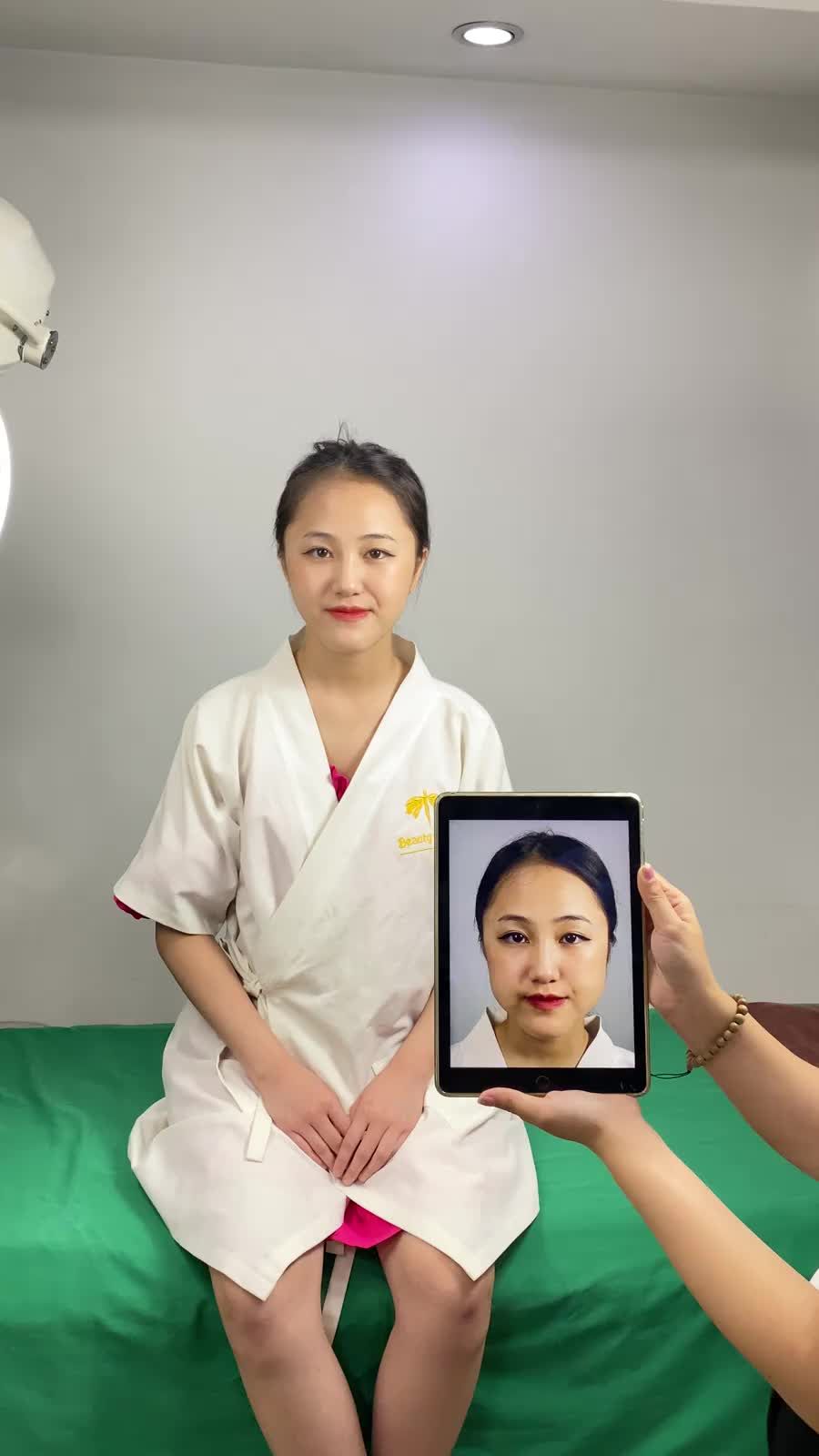 Bạn Phương Anh có tình trạng mặt to, vuông, góc hạm bạnh không thanh thoát, mặt lệch sang phải trước khi đến với TMV Tấm