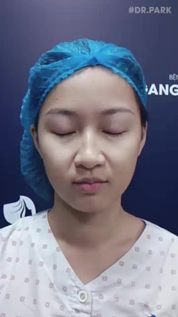 BẤM MÍ VĨNH VIỄN LÀ KỸ THUẬT TIÊN TIẾN NHẤT