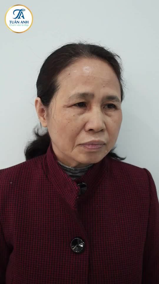 Chị khách hôm nay gặp tình trạng sụp mí cho lão hóa, mí chùng, nhăn, gây ảnh hưởng đến cuộc sống và công việc của chị. Cùng theo dõi BS. Tuấn Anh thay đổi ngoại hình của chị nhé!