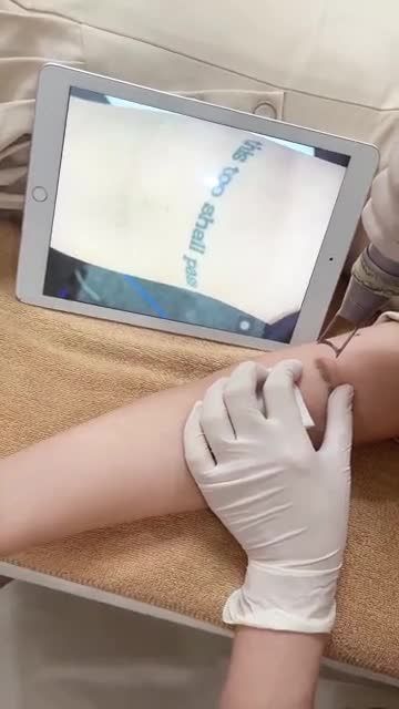 Mời cả nhà cùng theo dõi ca điều trị xóa xăm buổi 3 cho bạn khách hàng ngày hôm nay