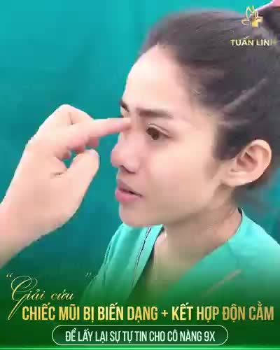Chị khách hàng đến với Tuấn Linh trong tình trạng chiếc mũi bị TẬT do nâng ở cơ sở khác mà không rõ nguyên nhân vì sao.