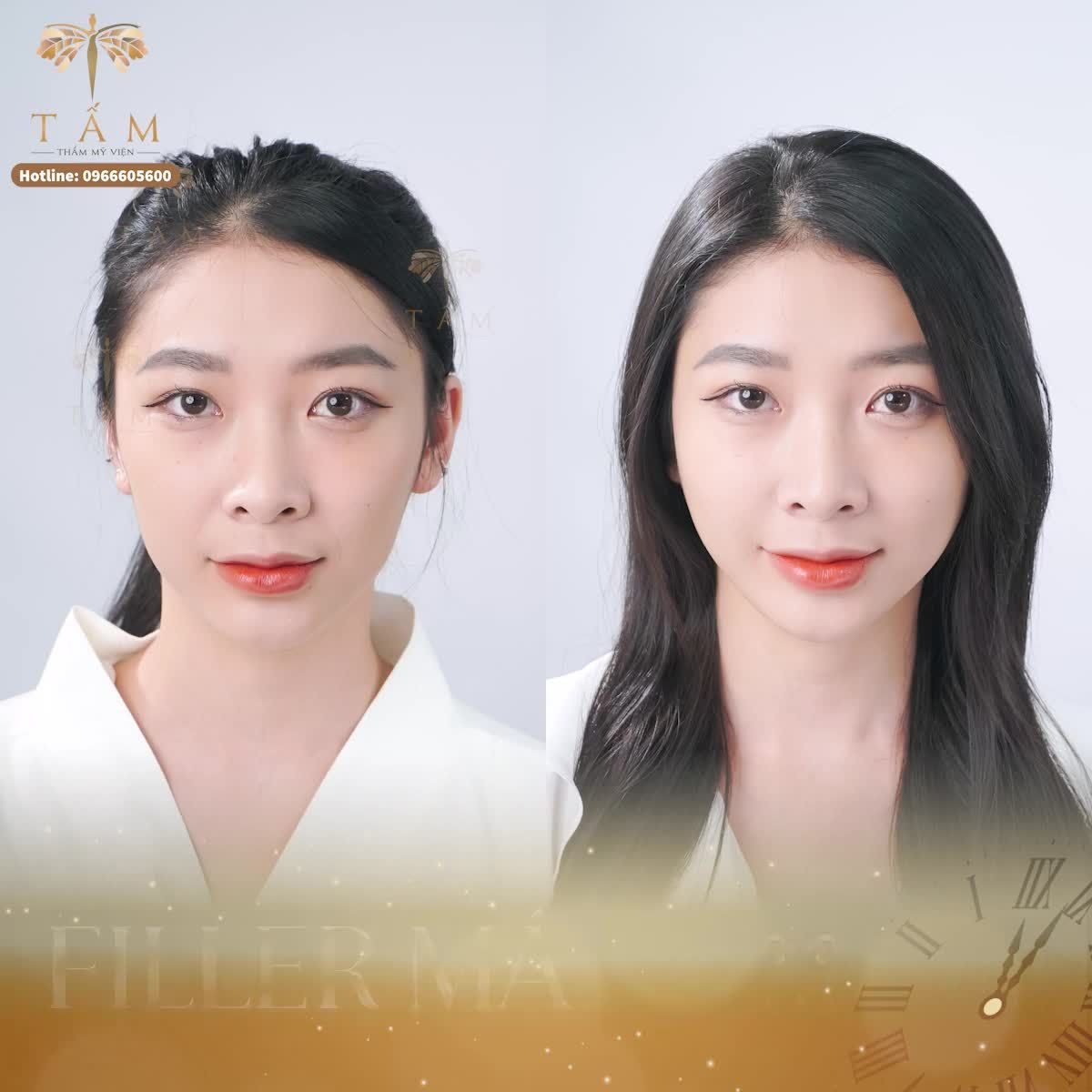 Tạm biệt tình trạng má góp chỉ sau 30 phút với Filler Má baby tại Tấm