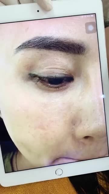 Hút mực xăm mí ''N'' lần tại cơ sở khác vẫn không hết, qua VTM Xuân Hương chỉ 1 buổi đã hiệu quả