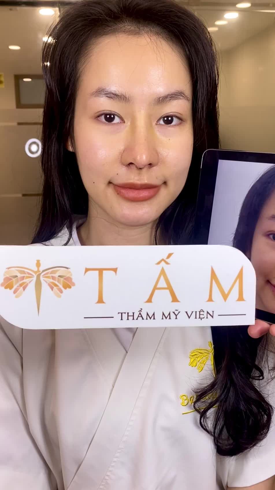 Tháo nẹp định hình mũi cho bạn Nga - khách hàng nâng mũi tái cấu trúc Reform ở TMV Tấm