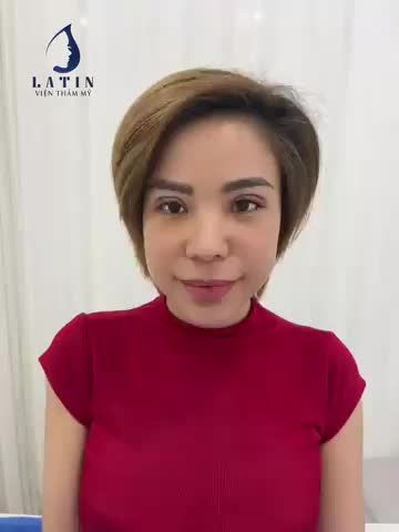 Hình ảnh khách nhà Latin tái khám sau 7 ngày cắt mí 4D