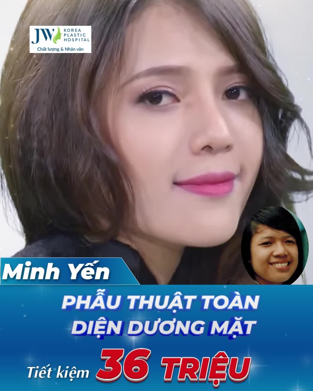 Top 5 VỊT HÓA THIÊN NGA sau Phẫu thuật hàm XINH ĐẸP ĐẾN KHÓ TIN
