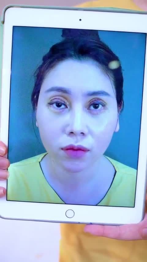 Mí mắt lỗi hỏng được chỉnh hình kịp thời trong thời điểm vàng 0-12 ngày ngăn chặn tối đa biến chứng Mời cả nhà cùng đón xem