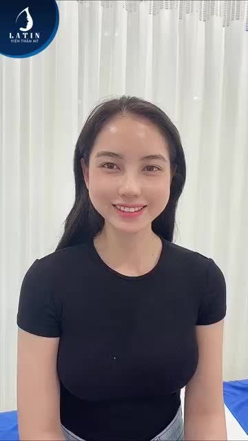 CẬN CẢNH MŨI CẤU TRÚC SỤN SURGIFORM SAU 10 NGÀY