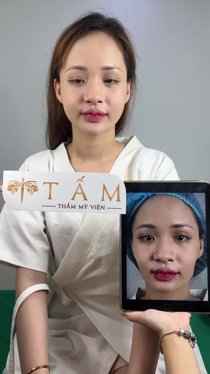 Ca cân chỉnh dáng cằm, làm đầy má tại phòng khám TMV Tấm.