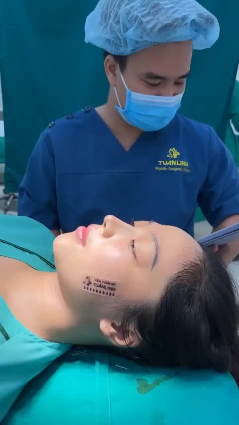 Case mũi bọc sụn 15tr vừa hoàn thành