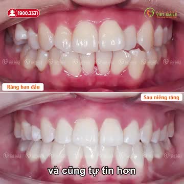 KẾT QUẢ SAU THÁO NIỀNG RĂNG HÔ, CHEN CHÚC