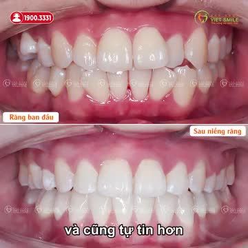 KẾT QUẢ SAU THÁO NIỀNG RĂNG HÔ, CHEN CHÚC